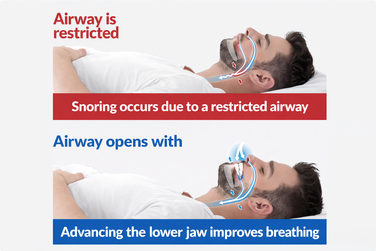 Adjustable Anti-Snoring Solution